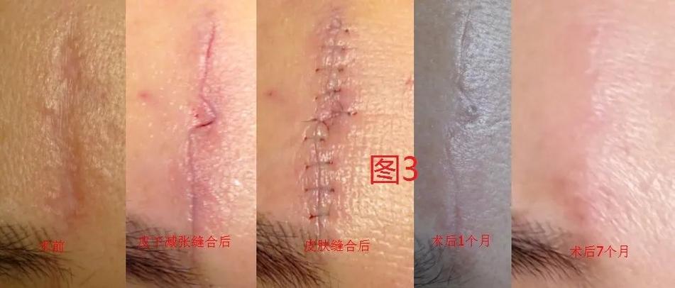 美容缝合视频教学
